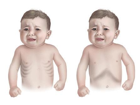 【康】婴幼儿急性支气管炎导致喘息的最佳治疗