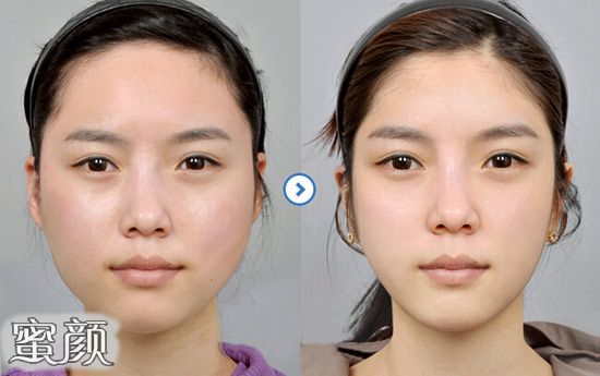 【美然】方形脸怎么改善脸型?磨骨改善方脸真实案例分享~