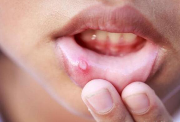 口腔溃疡是什么原因造成的 最有效的方法是补充维生素C