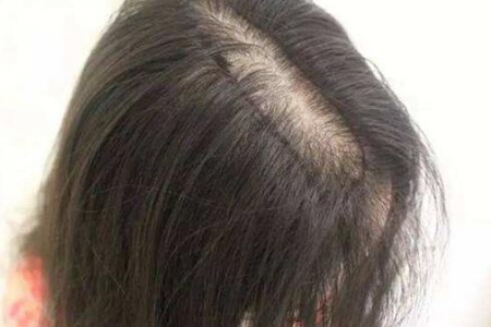 头发少怎么增加发量？这4个方法能让头发快速生长